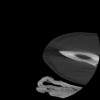 SPORK, NICO - 22.03.1976 - 02.08.2022 - CT obere Extremität - 17:51:17